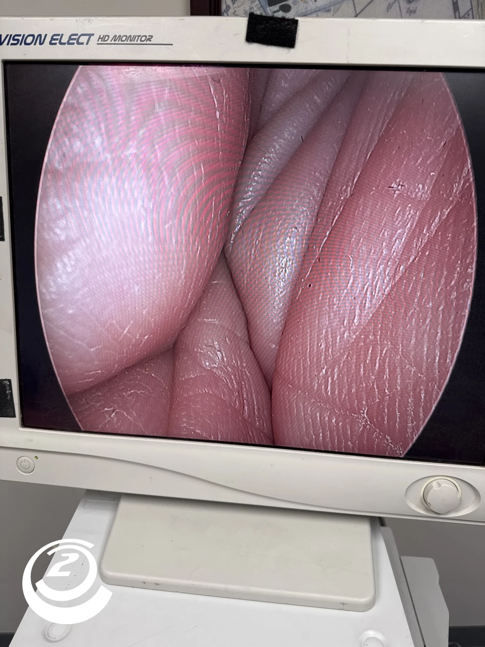 Stryker 0502-503-010