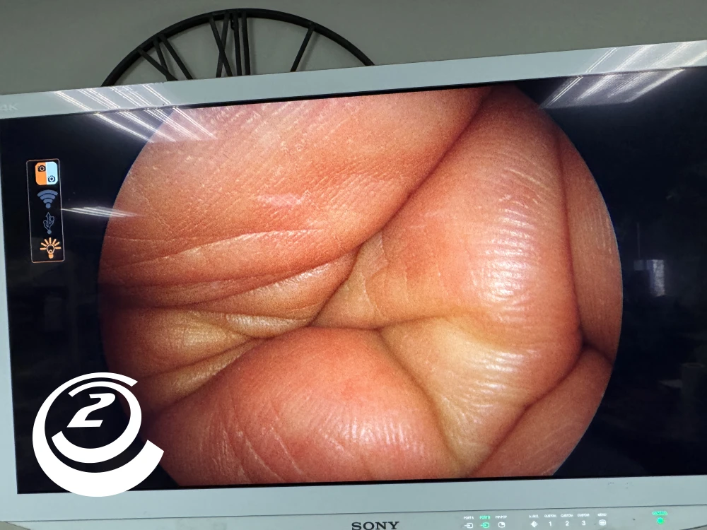 Smith & Nephew 72202087