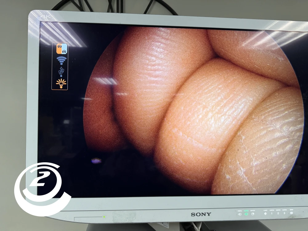 Smith & Nephew 72202087