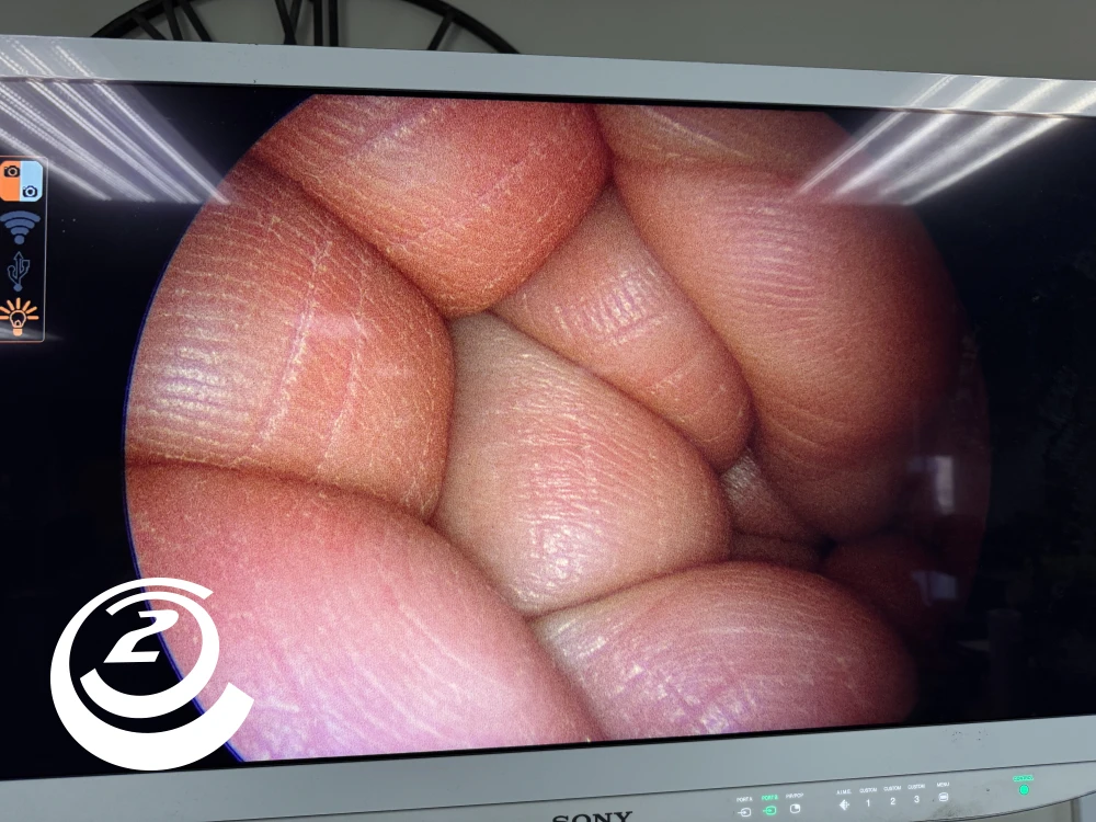 Smith & Nephew 72202087