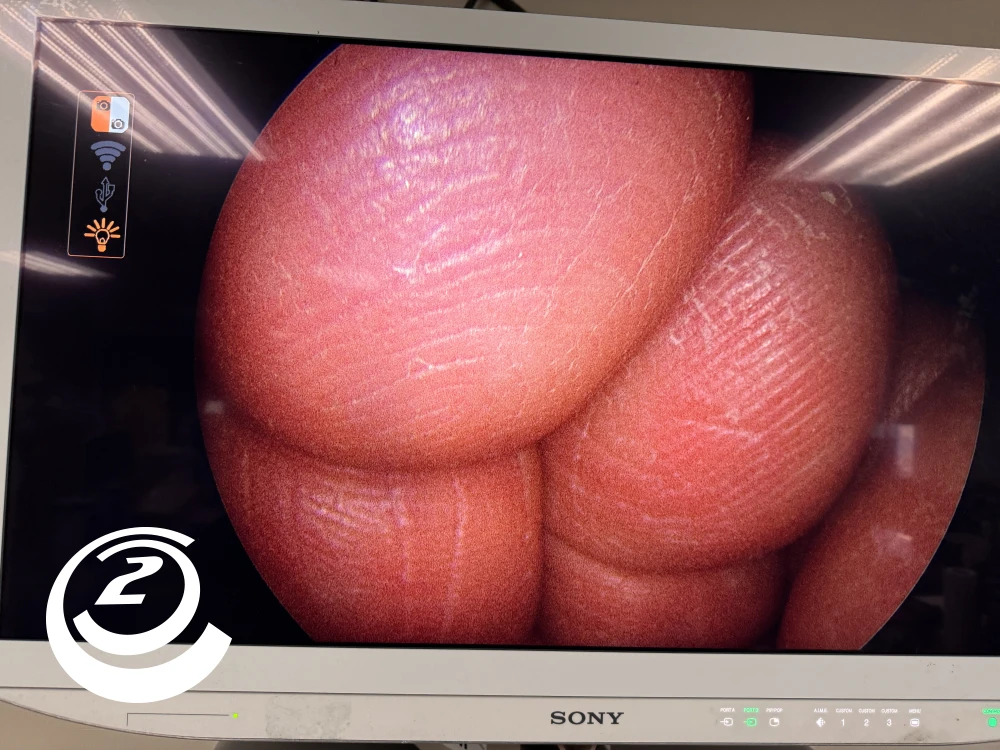 Smith & Nephew 72202087