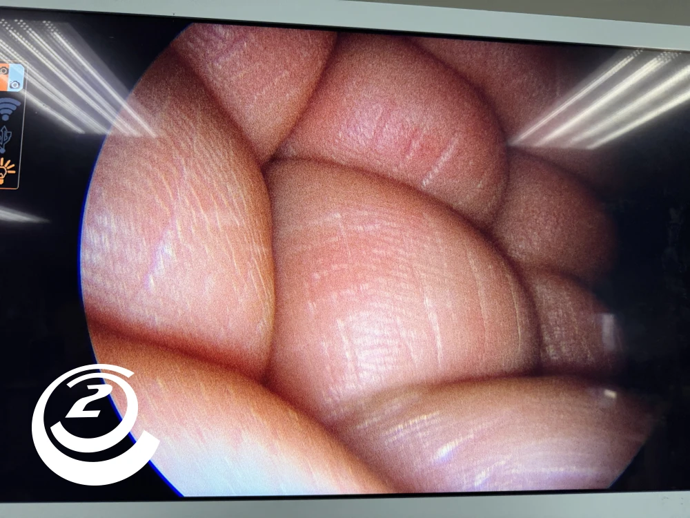 Smith & Nephew 72202088