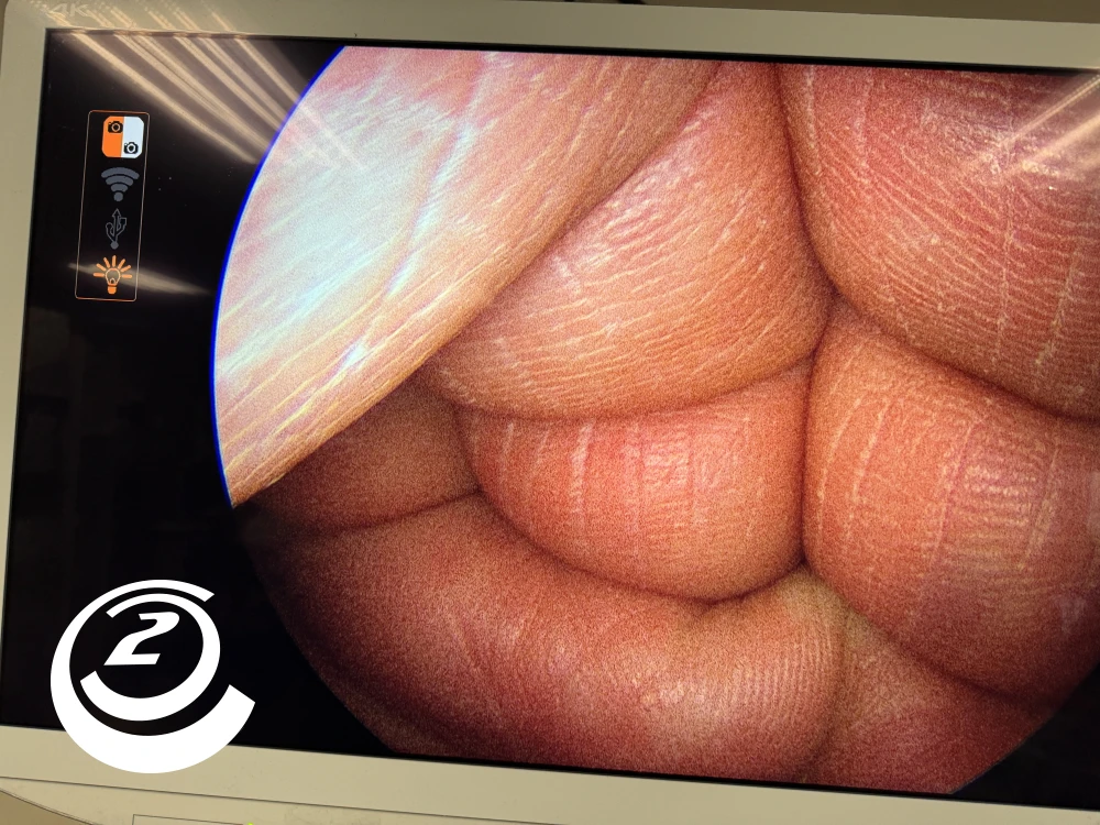 Smith & Nephew 72202087