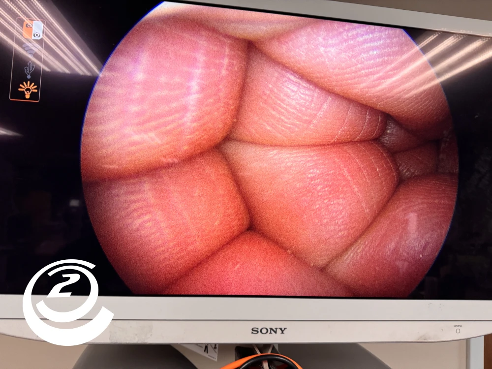 Smith & Nephew 72202087