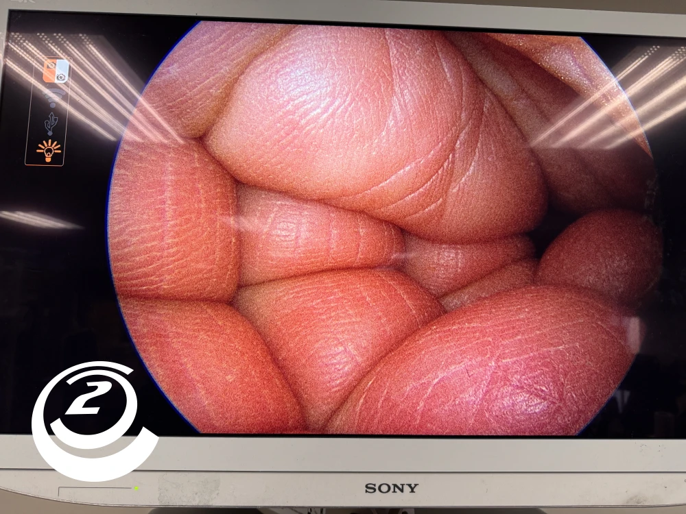 Smith & Nephew 72202087