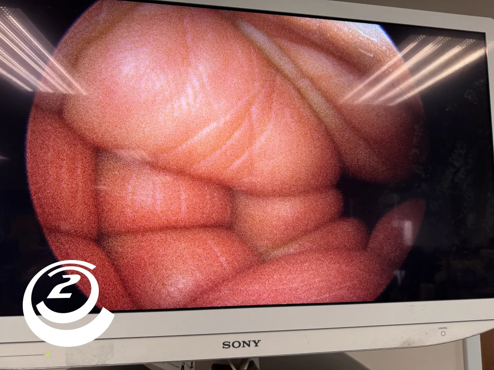 Smith & Nephew 72202087