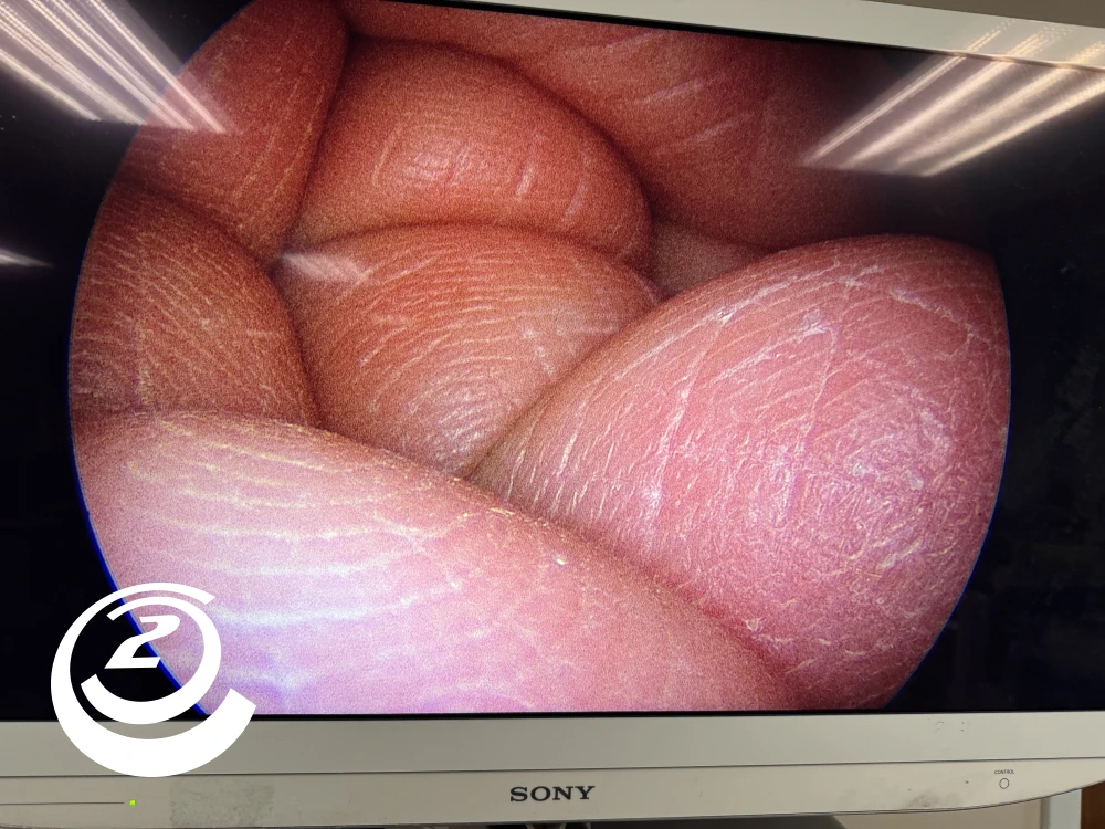 Smith & Nephew 72202087