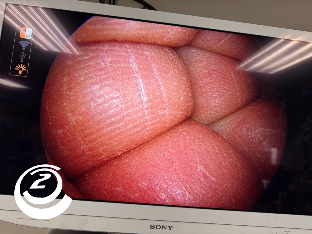 Smith & Nephew 72202088