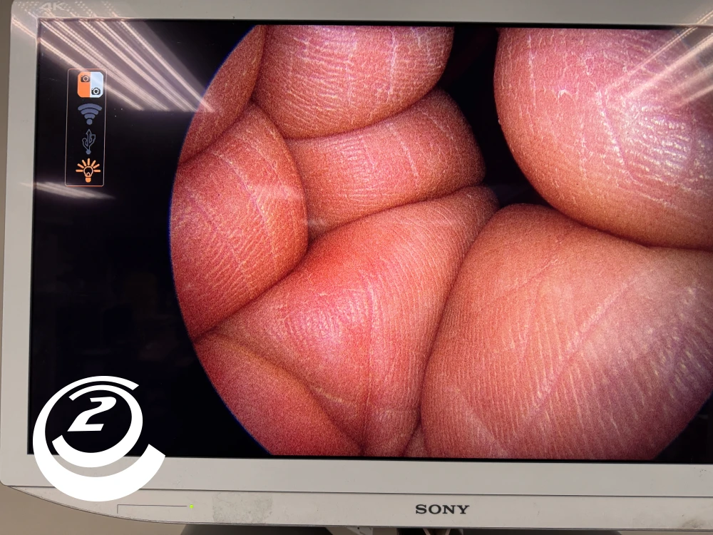 Smith & Nephew 72202088