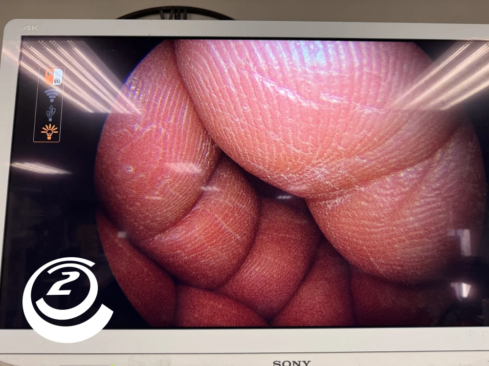 Smith & Nephew 72202087