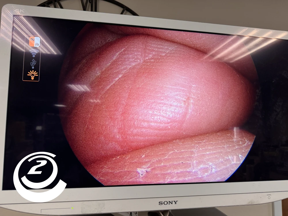 Smith & Nephew 72205058