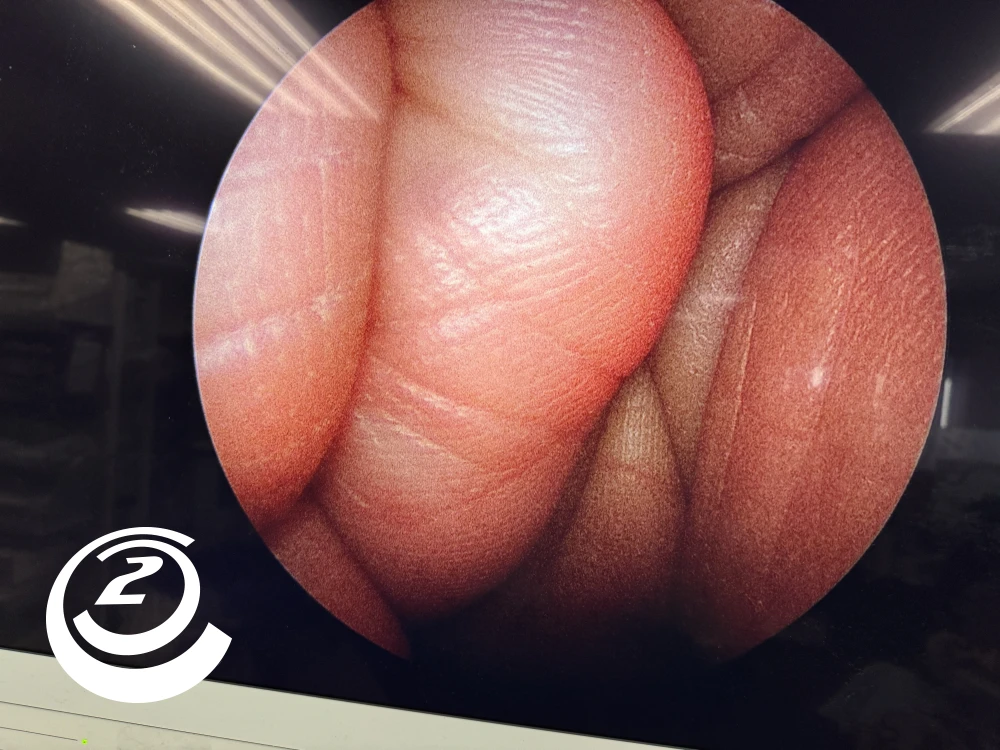 Smith & Nephew 72205058