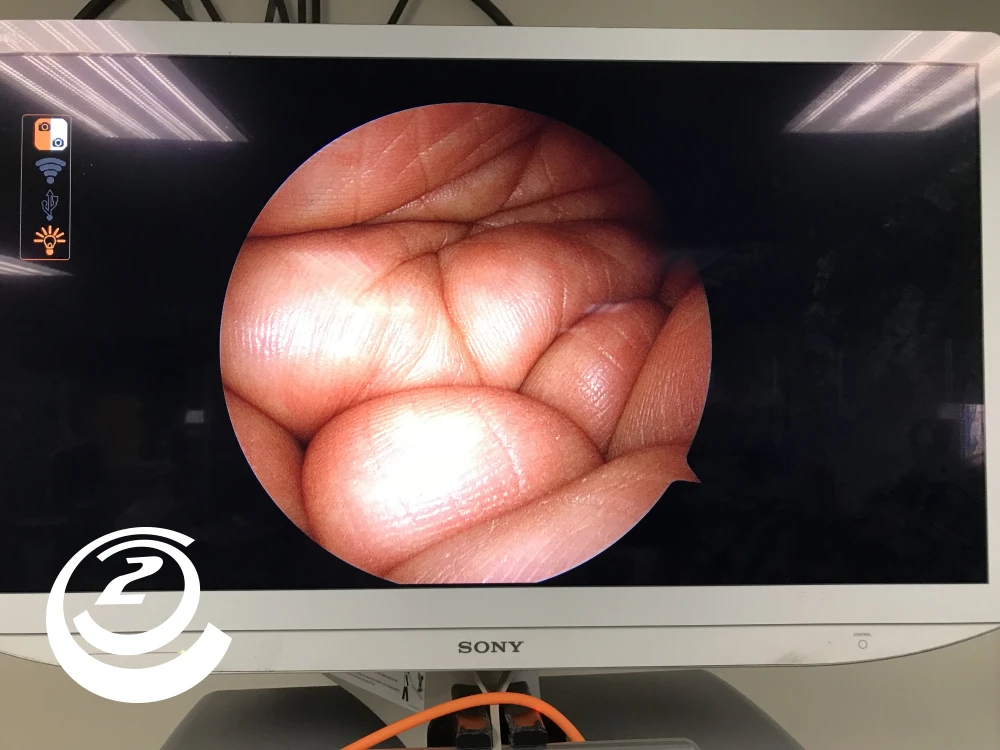 Smith & Nephew 72205058