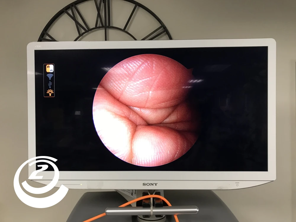 Smith & Nephew 72205058