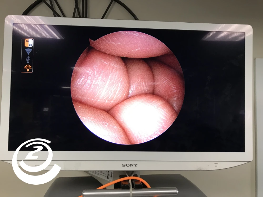 Smith & Nephew 72205058