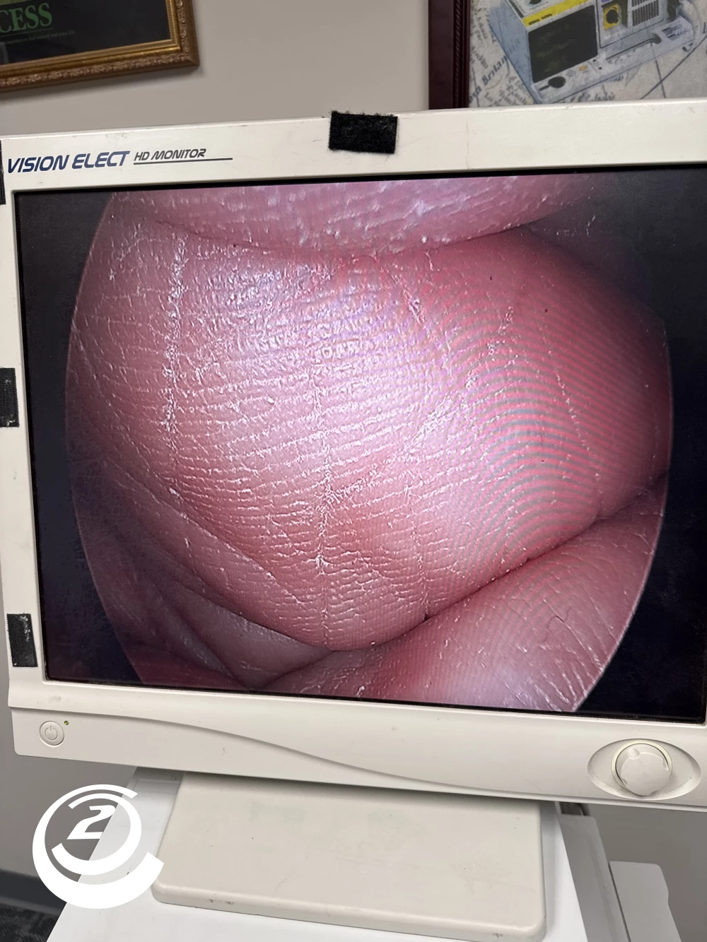 Stryker 0502-503-030