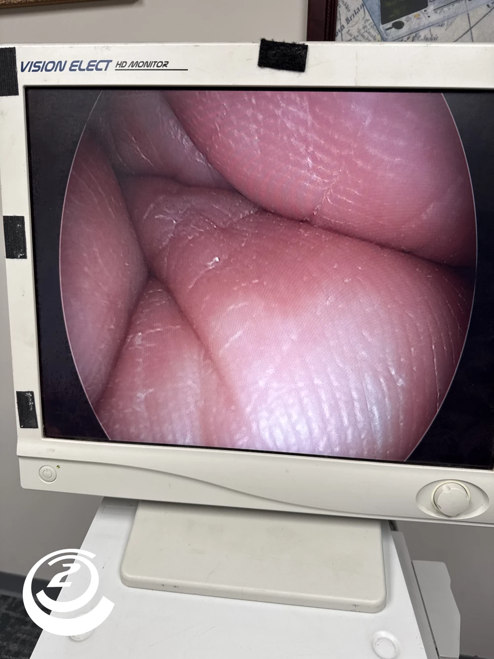 Stryker 0502-503-010