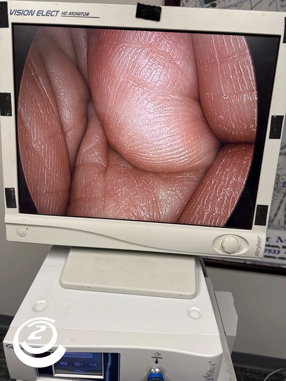 Stryker 0502-103-010