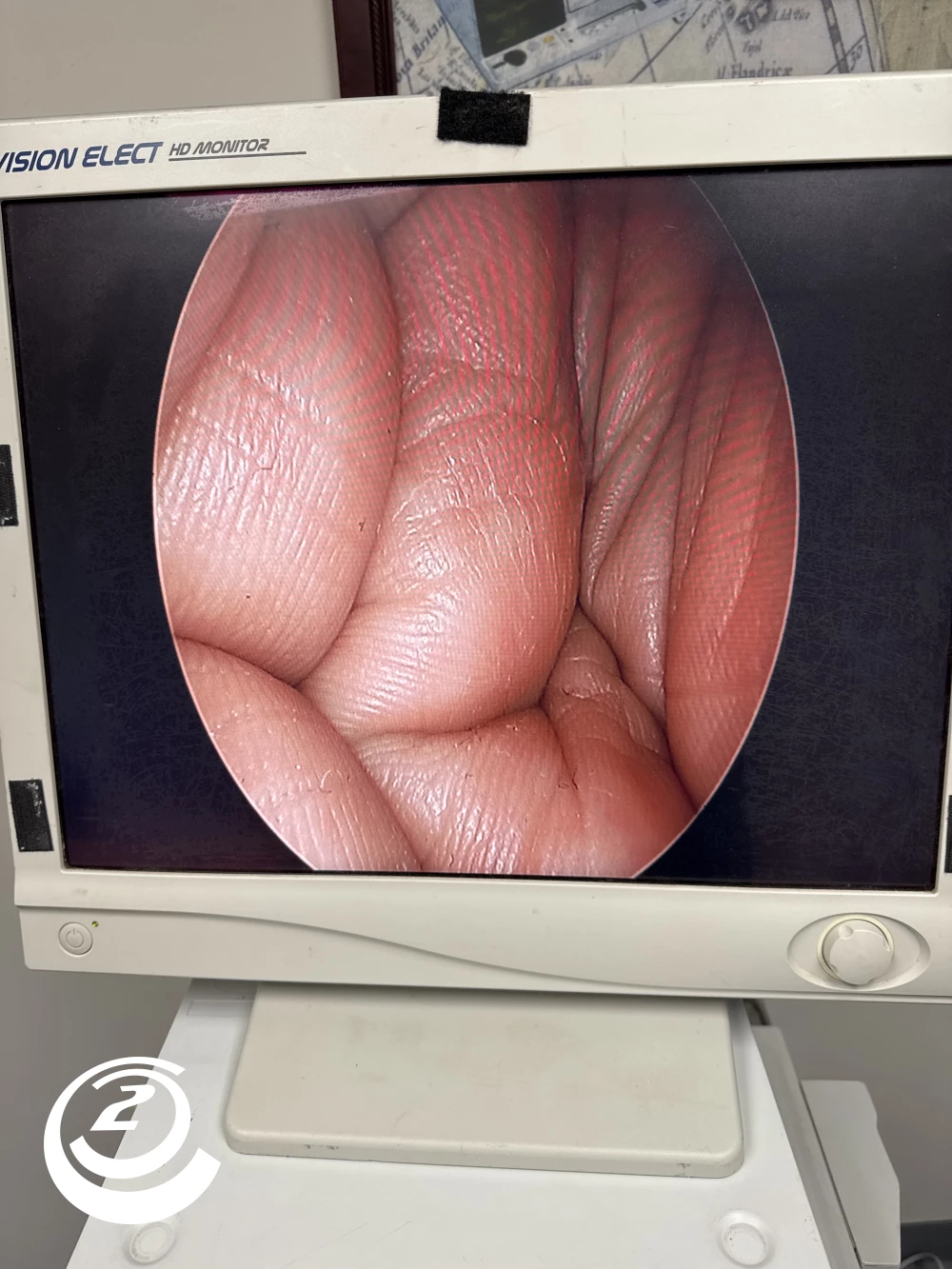 KARL STORZ Hopkins 27005 BA